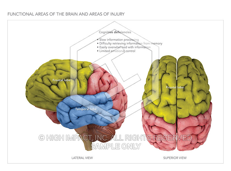 Image 10123: Functional Areas of the Brain and Areas of Injury Illustration - Trial Guides