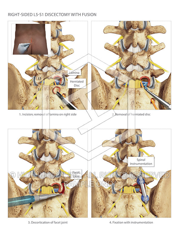 Image 10129: Discectomies and Fusion at L5-S1 Illustration - Trial Guides