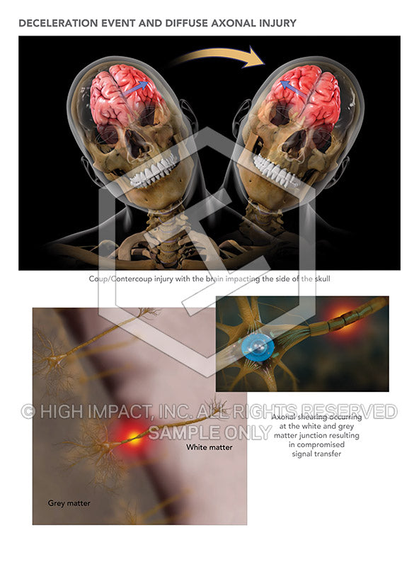 Image 10251: Deceleration Event and Diffuse Axonal Injury Illustration - Trial Guides