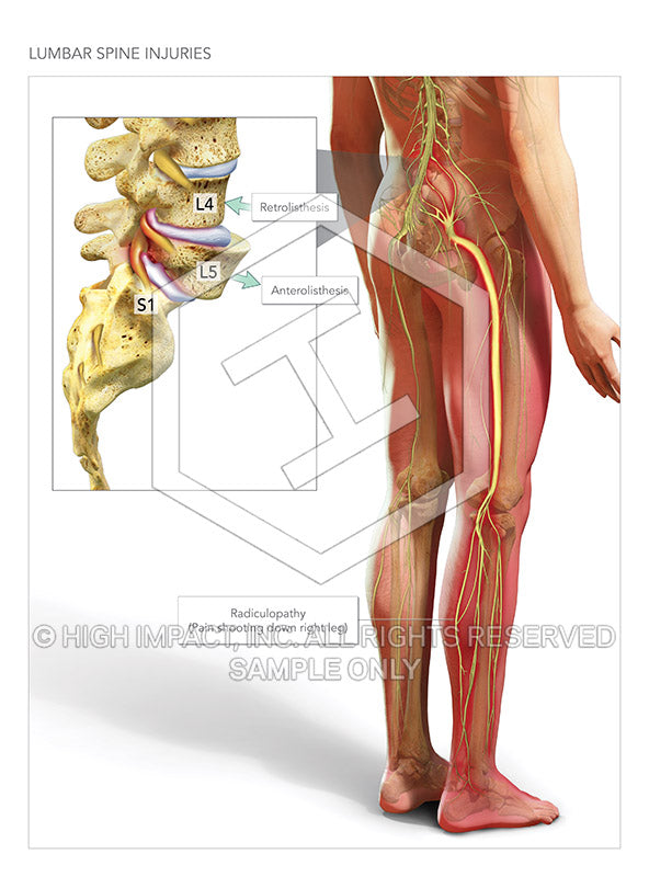 Image 10295: Lumbar Spondylolisthesis (Anterolisthesis / Retrolisthesis) Illustration - Trial Guides