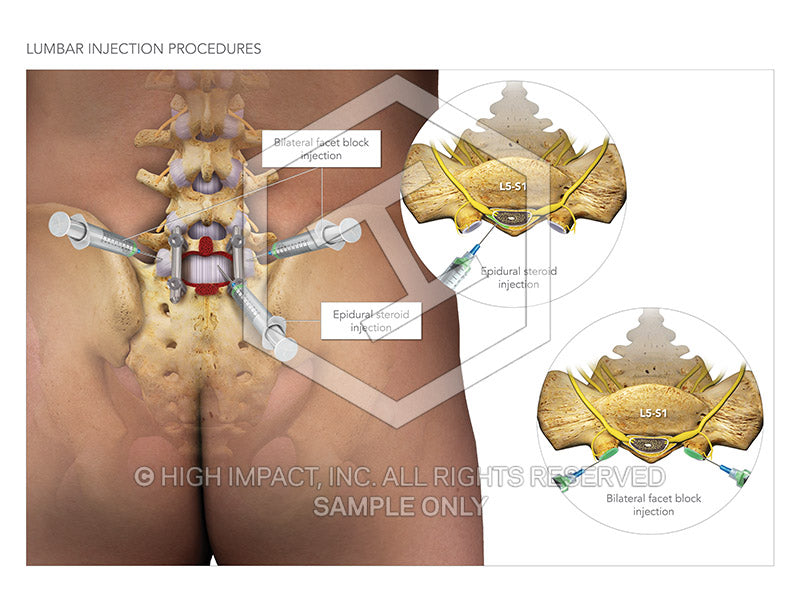 Image 10363_im01: Lumbosacral Injections Illustration - Trial Guides