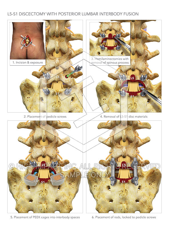 Image 10363_im03: L5 Discectomies with Posterior Lumbar Interbody Fusion Surgery at L5-S1 Illustration - Trial Guides