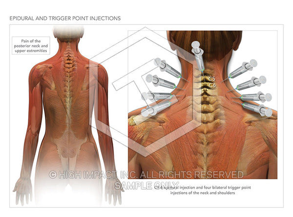 Image 10462: Cervical Epidural and Trigger Point Injections Illustration - Trial Guides