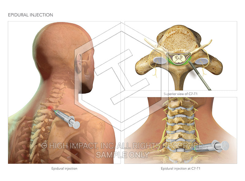 Image 10568_im01: Cervical Epidural Injections Illustration - Trial Guides