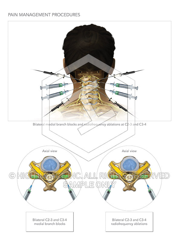 Image 10578: Cervical Spine Medial Branch Blocks and Radiofrequency Ablation Illustration - Trial Guides