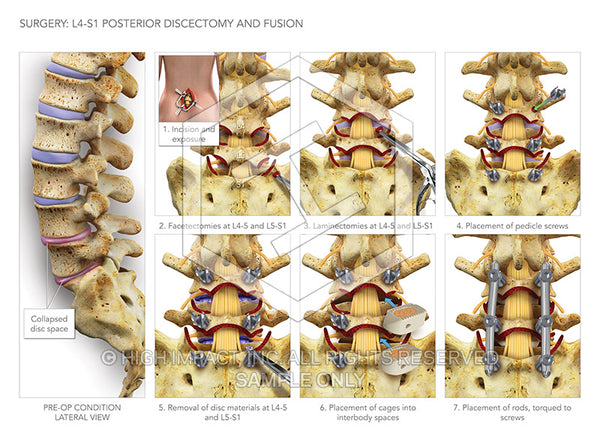 Image 10740: L4-S1 Posterior Discectomy with Fusion Surgery at L4-S1 Illustration - Trial Guides