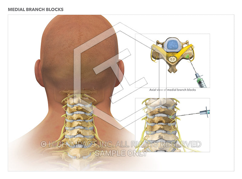 Image 10782: Cervical Spine Medial Branch Blocks Illustration - Trial Guides