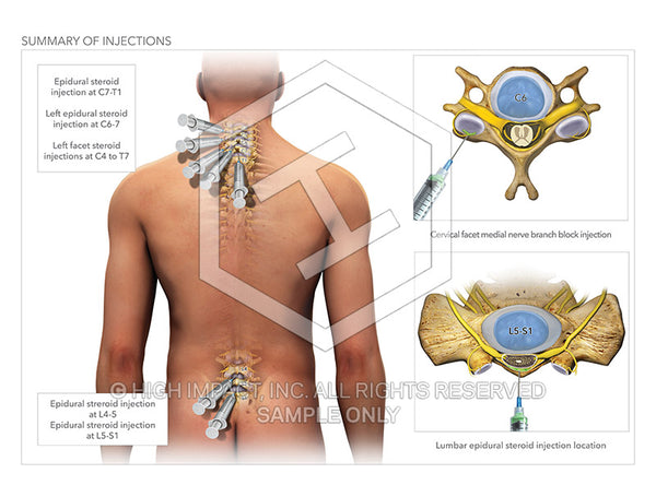 Image 10830: Cervical and Lumbar Spinal Injections Illustration - Trial Guides