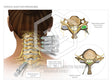 Image 10870_im01: Female Cervical Spine Medial Branch Blocks and Epidural Illustration - Trial Guides