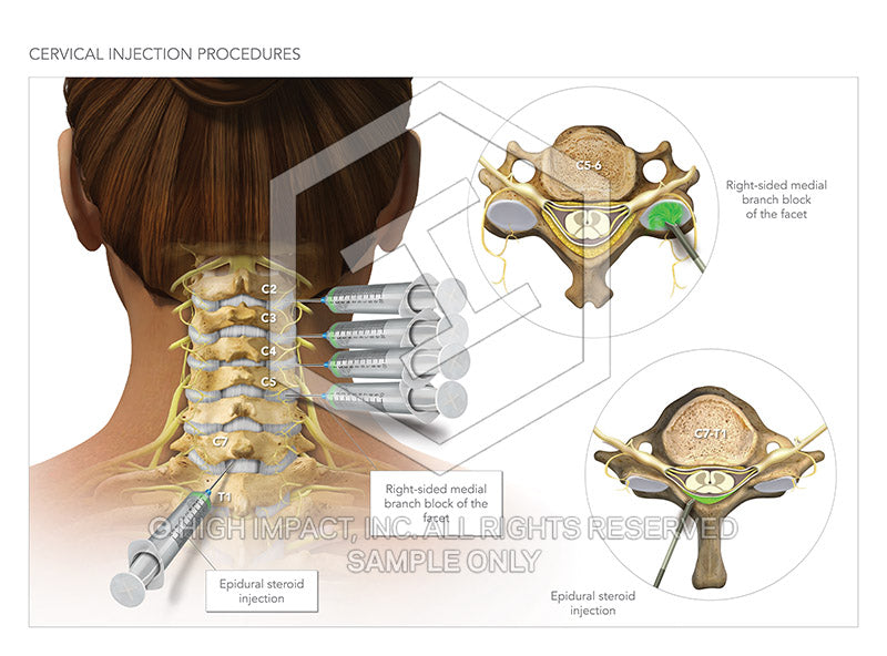 Image 10870_im01: Female Cervical Spine Medial Branch Blocks and Epidural Illustration - Trial Guides