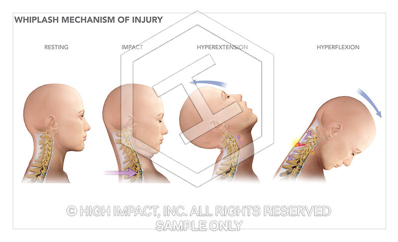 Image 10870_im02: Whiplash Mechanism of Injury Illustration - Trial Guides