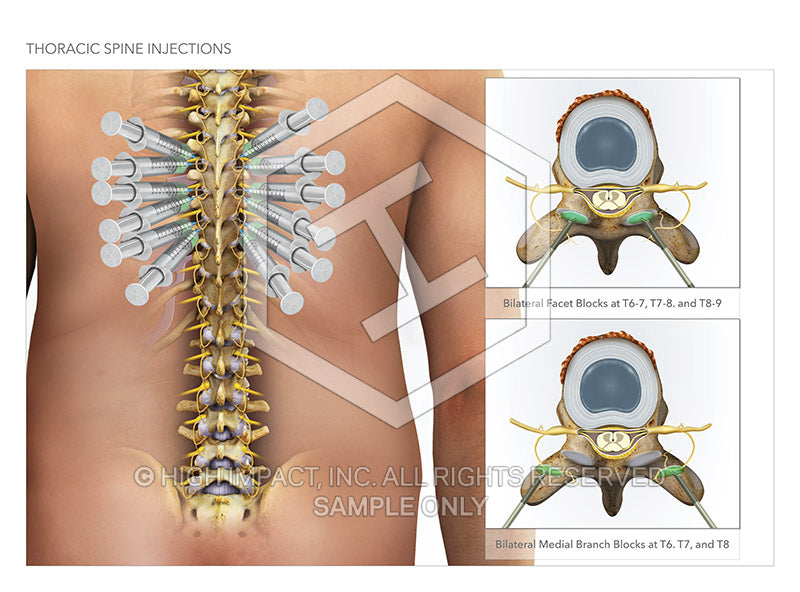 Image 10975: Thoracic Facet Injections and Medial Branch Blocks Illustration - Trial Guides