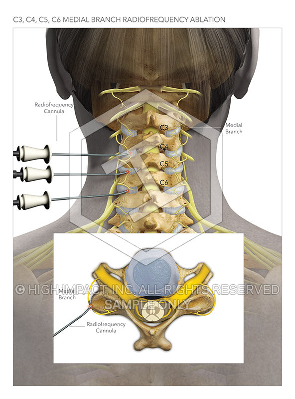 Image 11521: C3, C4, C5 C6 Medial Branch Radiofrequency Ablation Illustration - Trial Guides