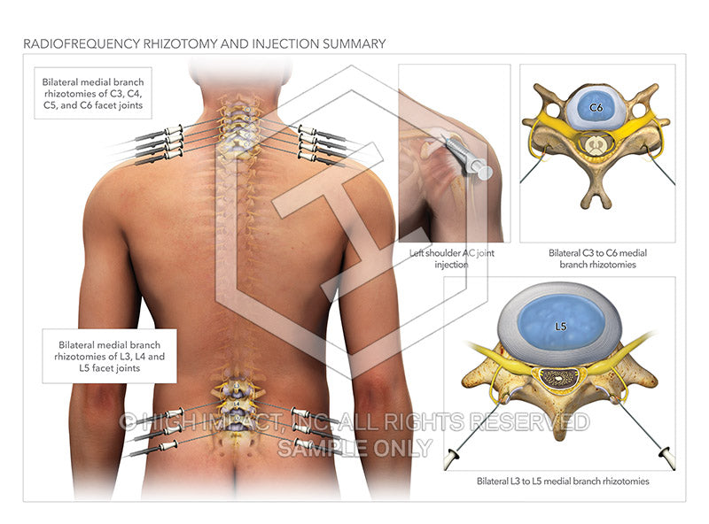 Image 11573: Spinal Radiofrequency Rhizotomy and Injection Illustration - Trial Guides
