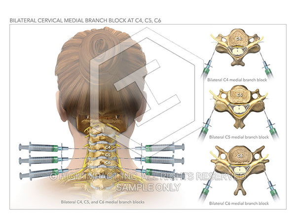 Image 11659: Female Cervical Spine Medial Branch Blocks and Epidural Illustration - Trial Guides