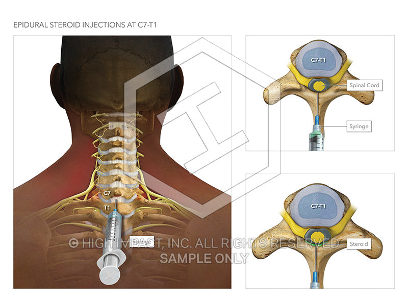 Image 11745: Cervical Epidural Steroid Injection Illustration - Trial Guides