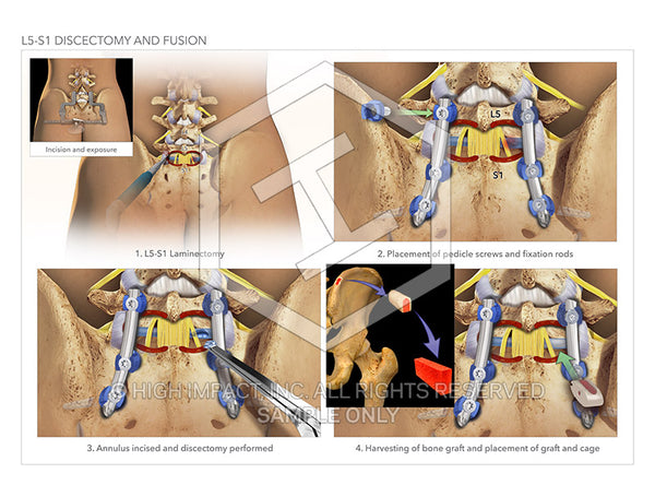 Image 11921_im01: L5-S1 Posterior Discectomy with Fusion Surgery Illustration - Trial Guides