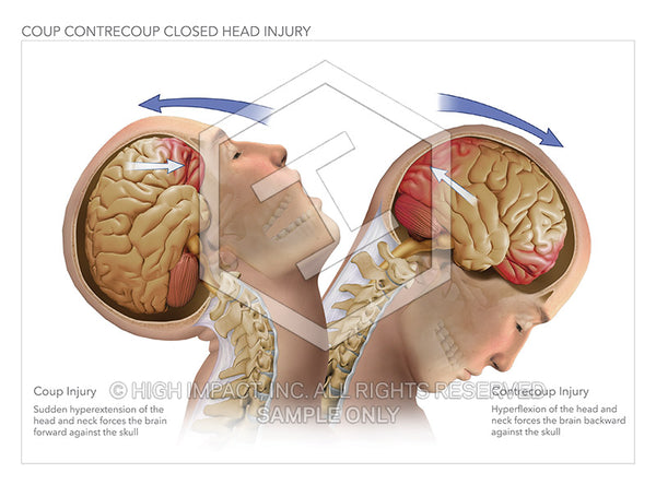 Image 11986: Coup Contrecoup Closed Head Injury Illustration - Trial Guides