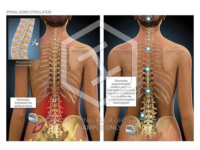 Image 12149: Cervical Spinal Cord Stimulator Device Illustration