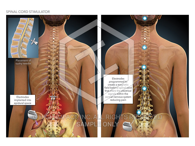 Image 12149: Cervical Spinal Cord Stimulator Device Illustration - Trial Guides