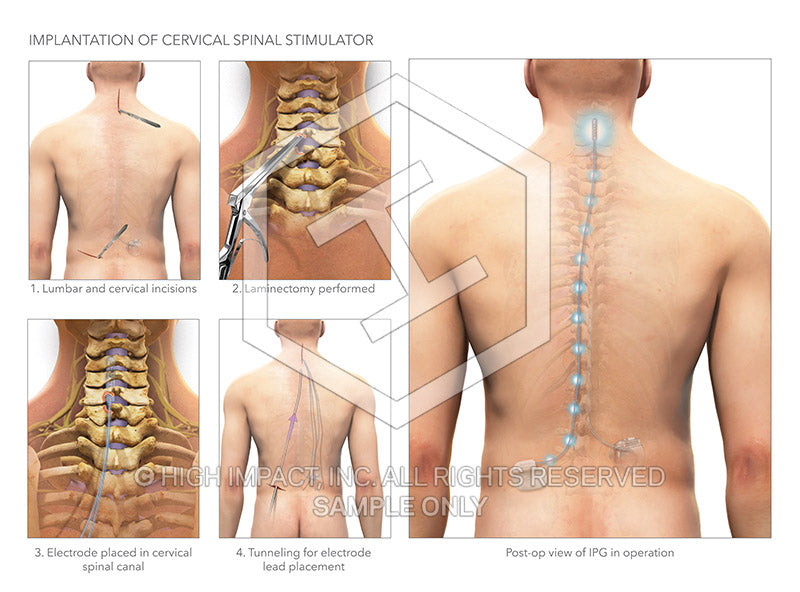 Image 12482: Implantation of a Cervical Spinal Cord Stimulator Illustration - Trial Guides