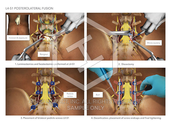 Image 12776: L4-S1 Posterior Discectomy with Fusion Surgery Illustration - Trial Guides