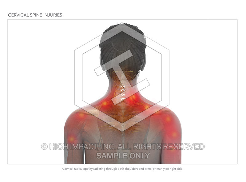 Image 12889: Bilateral Cervical Radiculopathy (radiating pain in the arms) Illustration - Trial Guides