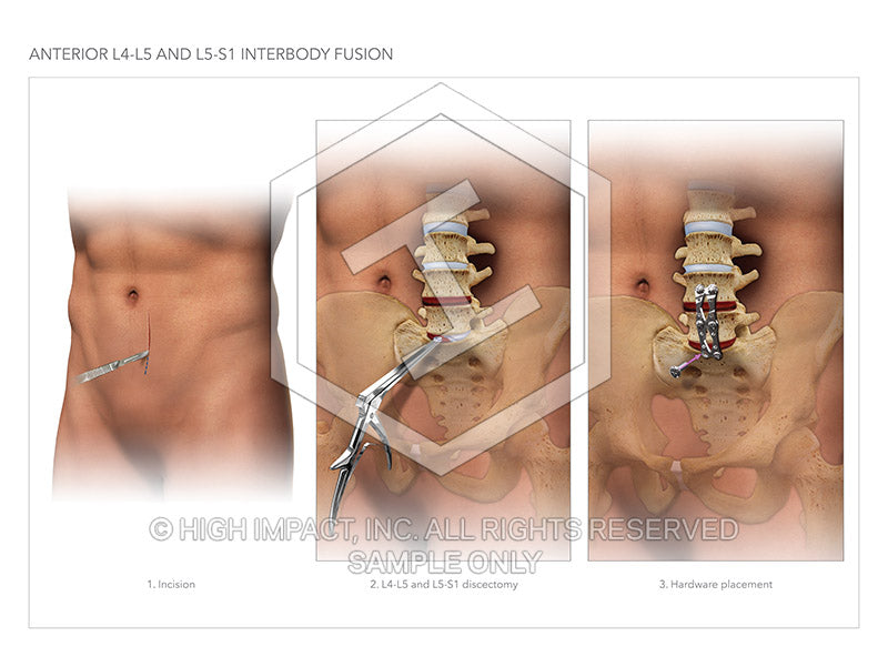 Image 12980: Anterior Discectomies and Interbody Fusion Surgery of L4-S1 Illustration - Trial Guides