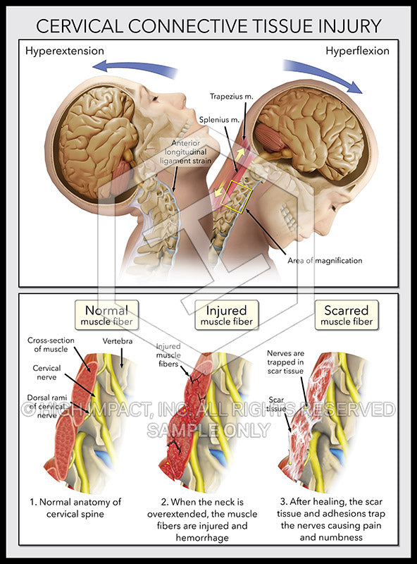 Image 12986: Cervical Connective Tissue Injury Illustration - Trial Guides