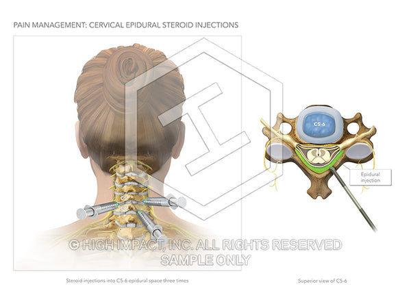 Image 13082_im01: Cervical Epidural Steroid Injections Illustration - Trial Guides