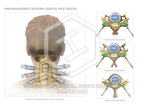Image 13082_im02: Cervical Facet Block Injections Illustration - Trial Guides