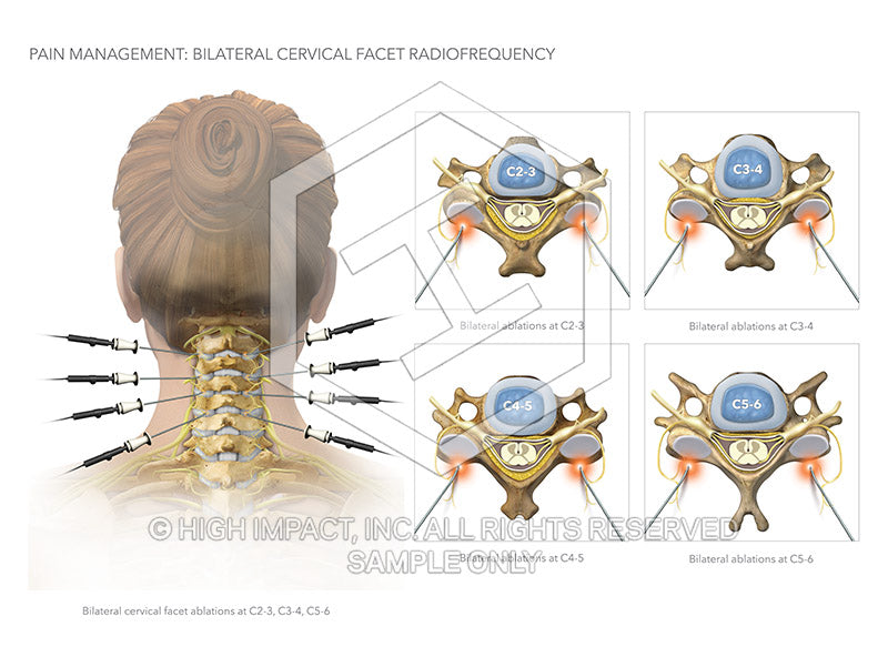 Image 13082_im03: Bilateral Cervical Facet Radiofrequency Ablation Illustration - Trial Guides