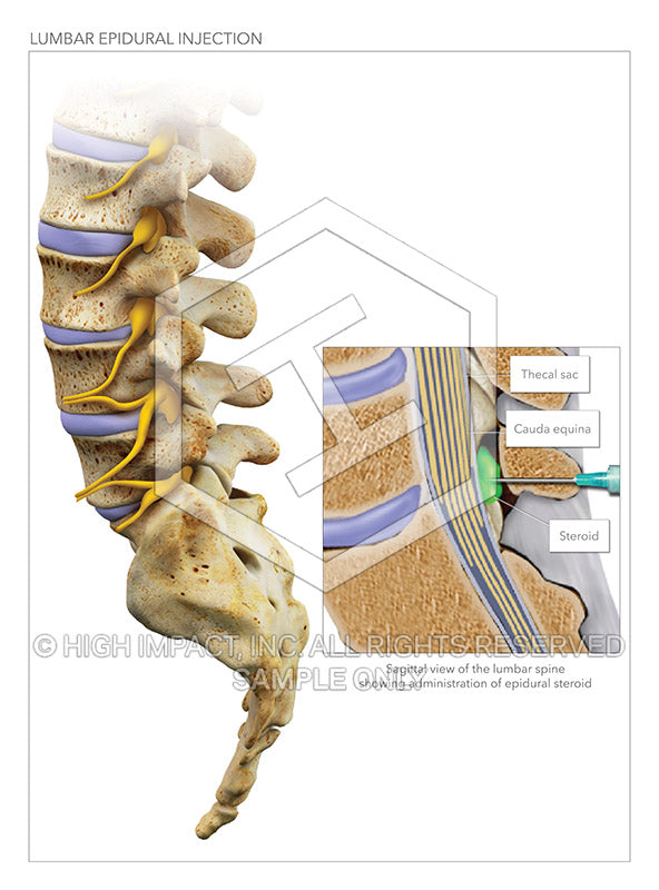 Image 13266_im01: Lumbar Epidural Steroid Injection Illustration - Trial Guides