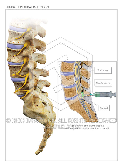 Image 13266_im02: Lumbar Epidural Steroid Injection of L5-S1 Illustrat