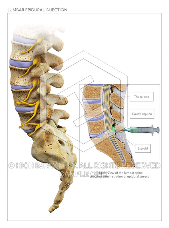 Image 13266_im02: Lumbar Epidural Steroid Injection of L5-S1 Illustration - Trial Guides