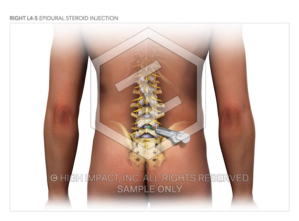 Image 13524:  L4-5 Epidural Steroid Injections Illustration - Trial Guides