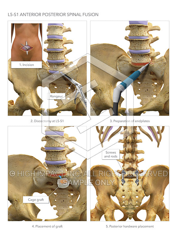 Image 13558: Anterior Posterior Discectomy and Fusion Surgery of L5-S1 Illustration - Trial Guides