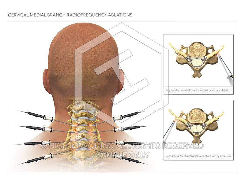 Image 13868_im01: Bilateral Cervical Facet Radiofrequency Ablation Illustration - Trial Guides