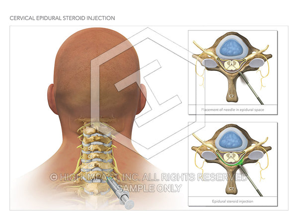 Image 13868_im02: Cervical Epidural Steroid Injection Illustration - Trial Guides