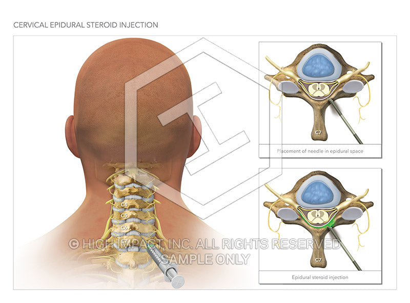Image 13868_im02: Cervical Epidural Steroid Injection Illustration - Trial Guides