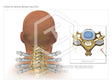 Image 13868_im03: Cervical Medial Branch Blocks Illustration - Trial Guides