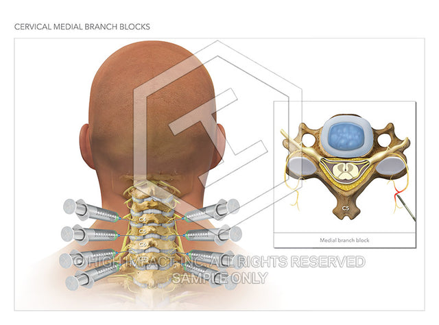 Image 13868_im03: Cervical Medial Branch Blocks Illustration - Trial Guides