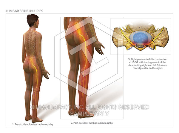 Image 13879: Lumbar Spine Injury with Sciatica / Radiculopathy Illustration - Trial Guides