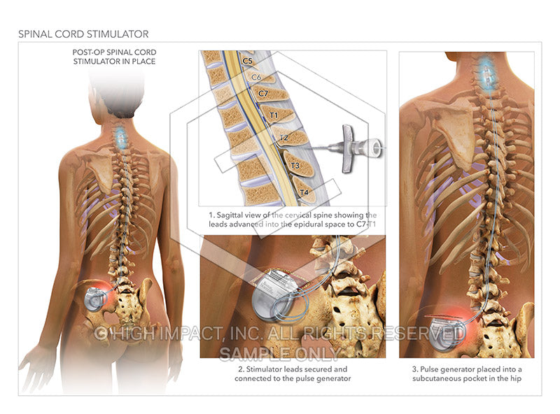 Image 14305: Spinal Cord Stimulator Illustration - Trial Guides