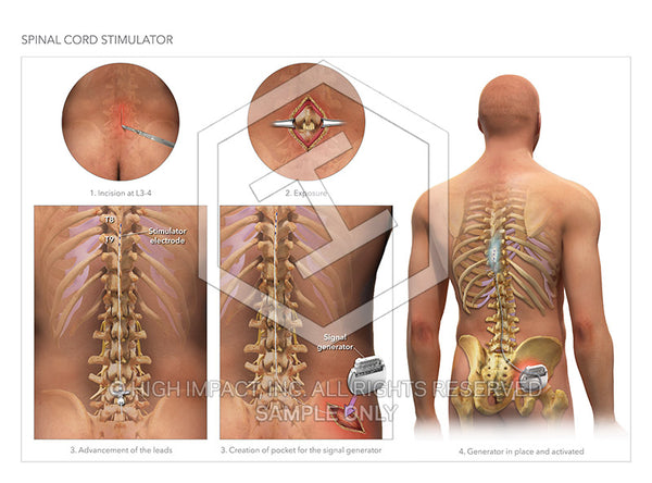 Image 14373: Spinal Cord Stimulator Illustration - Trial Guides