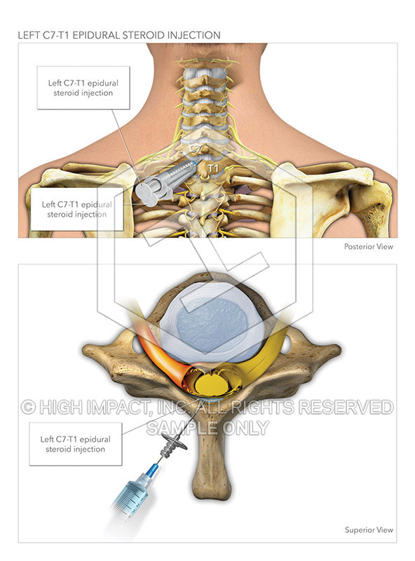 Image 14411: Cervical Epidural Steroid Injection Illustration - Trial Guides