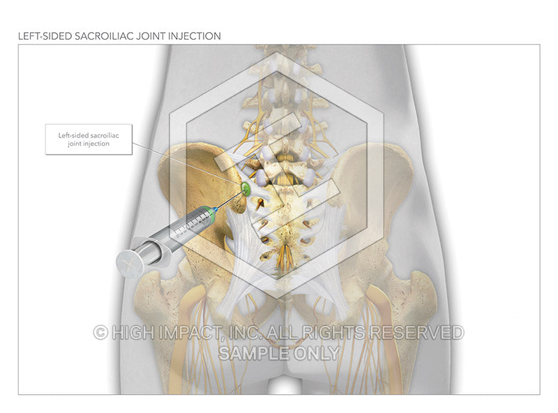 Image 14518: Sacroiliac Joint Injections Illustration - Trial Guides