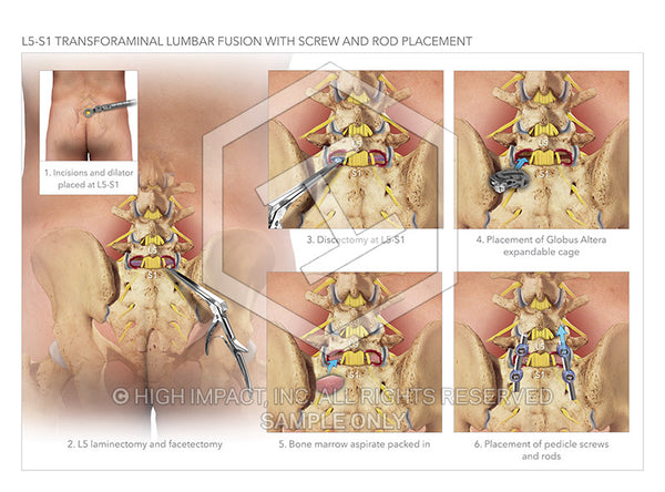 Image 14532: Transforaminal Fusion Surgery of L5-S1 with Screw and Rod Placement Illustration - Trial Guides
