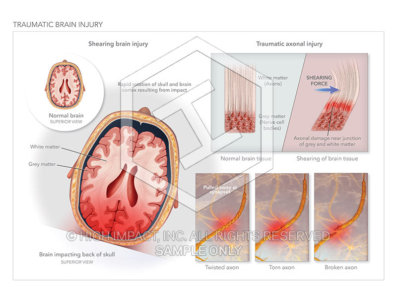 Image 18350_im01: Traumatic Brain Injury Illustration - Trial Guides