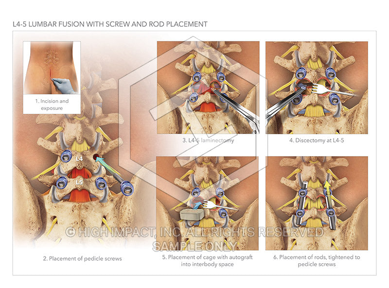Image 18372: Lumbar Fusion Surgery at L4-L5 Using an Autograft Illustration - Trial Guides